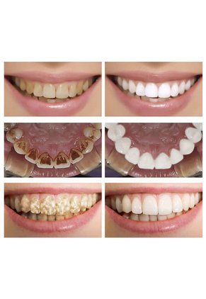 Blanqueador Dental Y Removedor De Placa Instantaneo Marca Lanbena X 0.35 Fl Oz.